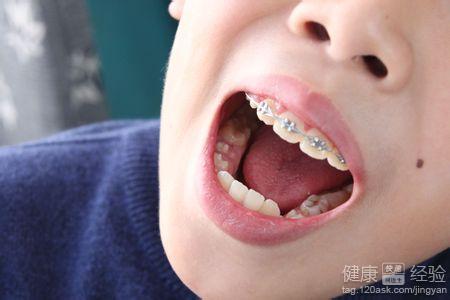 怎麼可以減少牙齒畸形出現呢