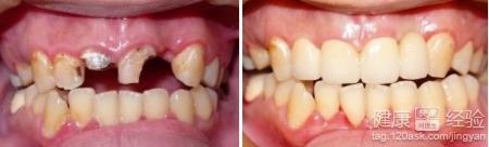 牙齒缺失通常有幾種解決方法呢