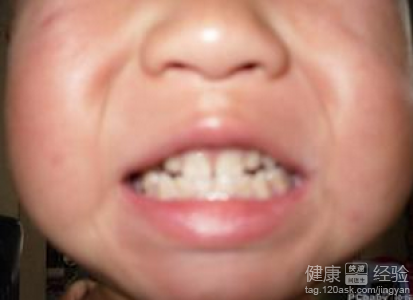 幼兒牙齒發黃怎麼護理