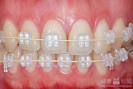 牙齒矯正手術什麼年齡