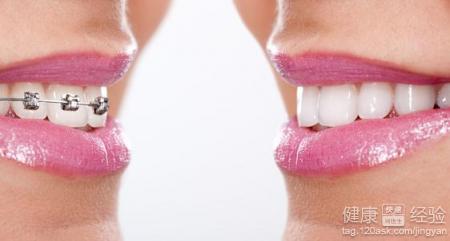 牙齒矯正有幾種方法