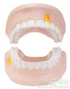 成人牙齒矯正方法