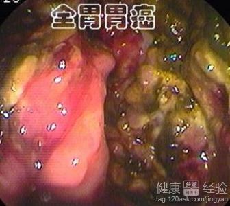 口臭怎麼來的