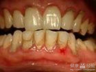 藥物性的牙龈增生怎麼辦