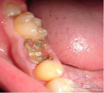 颌面部放線菌病患者吃什麼好？