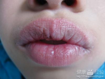 治療唇炎有好辦法嗎