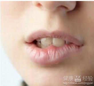 嘴唇干裂是引發唇炎的原因嗎