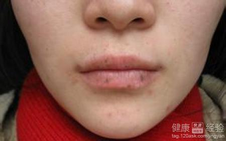 過敏性唇炎已經四年了還可以治愈嗎