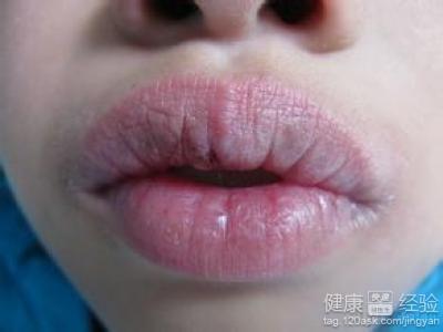 有什麼好的方案治療唇炎嗎