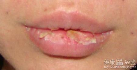 過敏性唇炎有什麼偏方可以治療呢