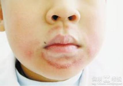 兒童唇炎如何防治