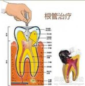 急性牙髓炎怎麼辦
