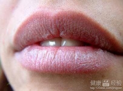 唇炎的病因有哪些？