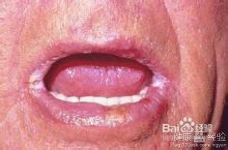 疱疹性的口角炎和霉菌性的口角炎有什麼不同
