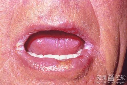 球菌性口角炎嚴重嗎
