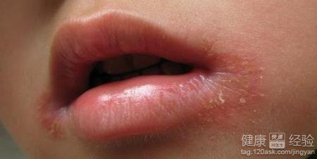 口角炎是不是和營良不良有關呢