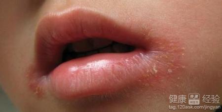 口角炎是怎麼回事？