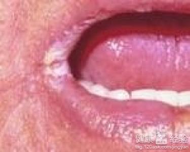口角炎是什麼原因？