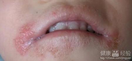 口角炎是怎麼回事