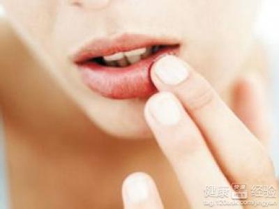 口角炎是免疫系統出了什麼問題嗎