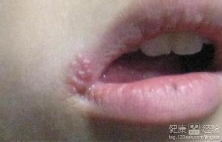 嘴邊長小紅點，有潰爛現象是疱疹還是口角炎