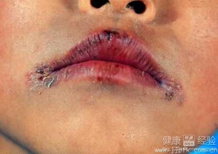 口角炎治療的方法有哪些？