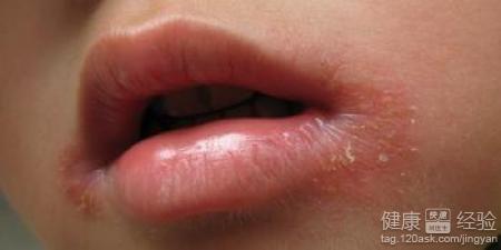 口角炎是怎麼發生的可以治愈嗎？