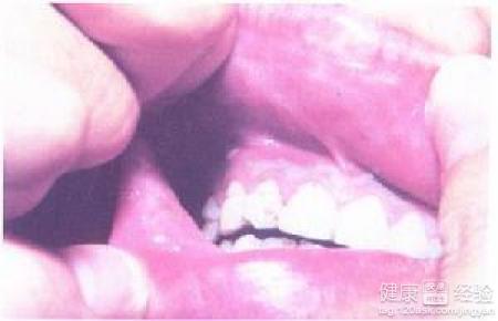 得了口角炎吃什麼好