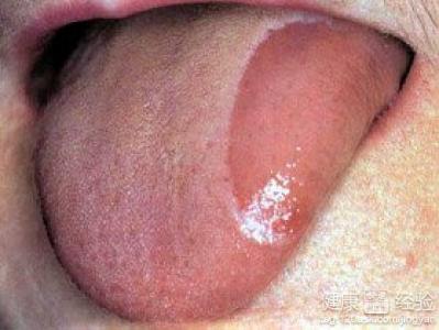舌炎可以吃什麼水果來緩解症狀