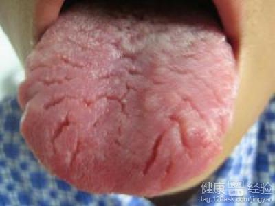血紅蛋白低是舌炎嗎