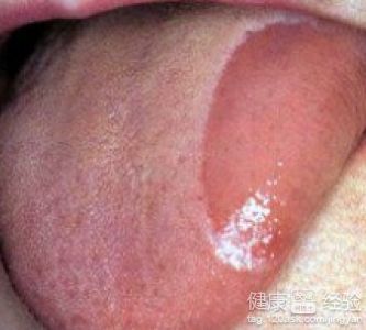萎縮性舌炎患者的疼痛會持續多久