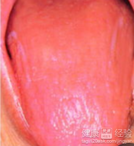 舌炎要吃什麼藥才能好