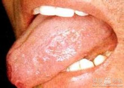 舌炎，干燥綜合症有並發症嗎