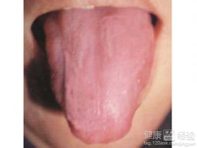 萎縮性舌炎是否會傳染