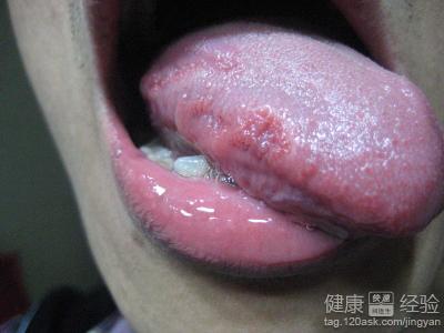 慢性舌炎會不會變成舌癌