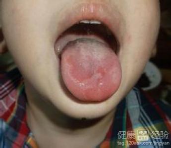 舌炎前牙舌側發熱難受用了好多藥不行怎麼辦