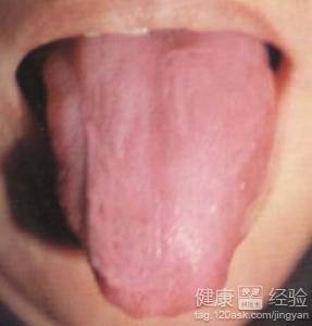 萎縮性舌炎怎樣治療