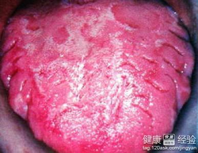 中醫治療舌炎怎麼做