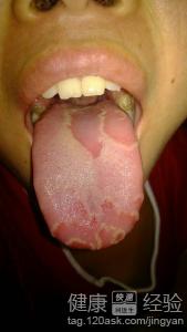 舌炎有啥藥可以緩解症狀