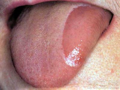 舌頭破皮不知道是不是舌炎，怎麼辦呢
