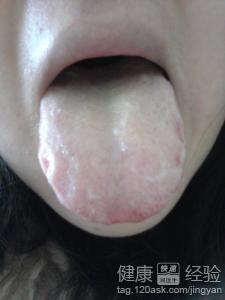 慢性舌炎有10幾年了，反復發作，無法斷根怎麼辦