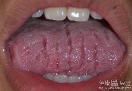 舌頭老有是殺疼的感覺看口腔科說是舌炎怎麼辦