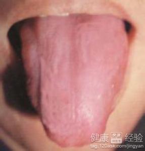 萎縮性舌炎2年，怎麼也治不好怎麼辦