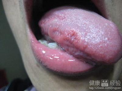 有裂紋性的舌炎，有辦法根治嗎