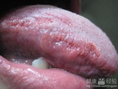 老年人患舌炎已經3年了，舌頭赤紅該怎麼治療呢