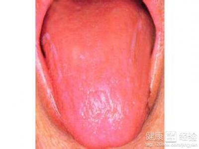 光滑型舌炎該怎麼治療