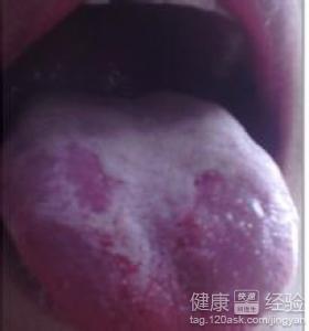 微縮性舌炎怎麼治