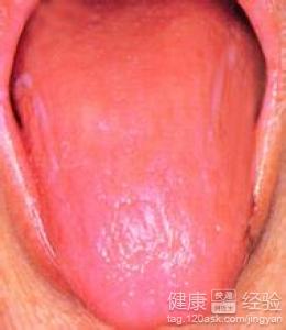 得了萎縮性舌炎怎麼治療