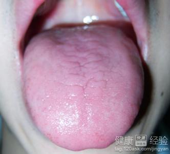 口腔舌炎有什麼偏方可治嗎
