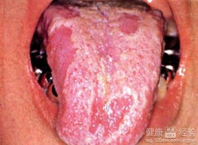 舌頭上發紅，得了舌炎，疼痛有3個多月了怎麼辦